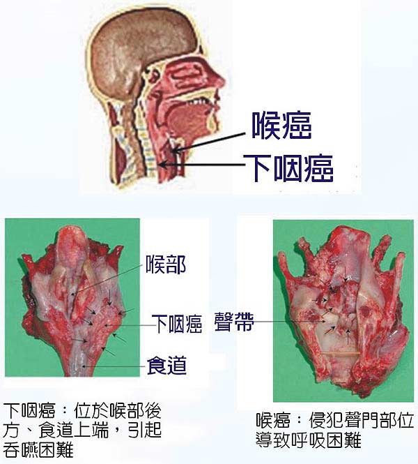 菸酒檳榔與咽喉癌圖象